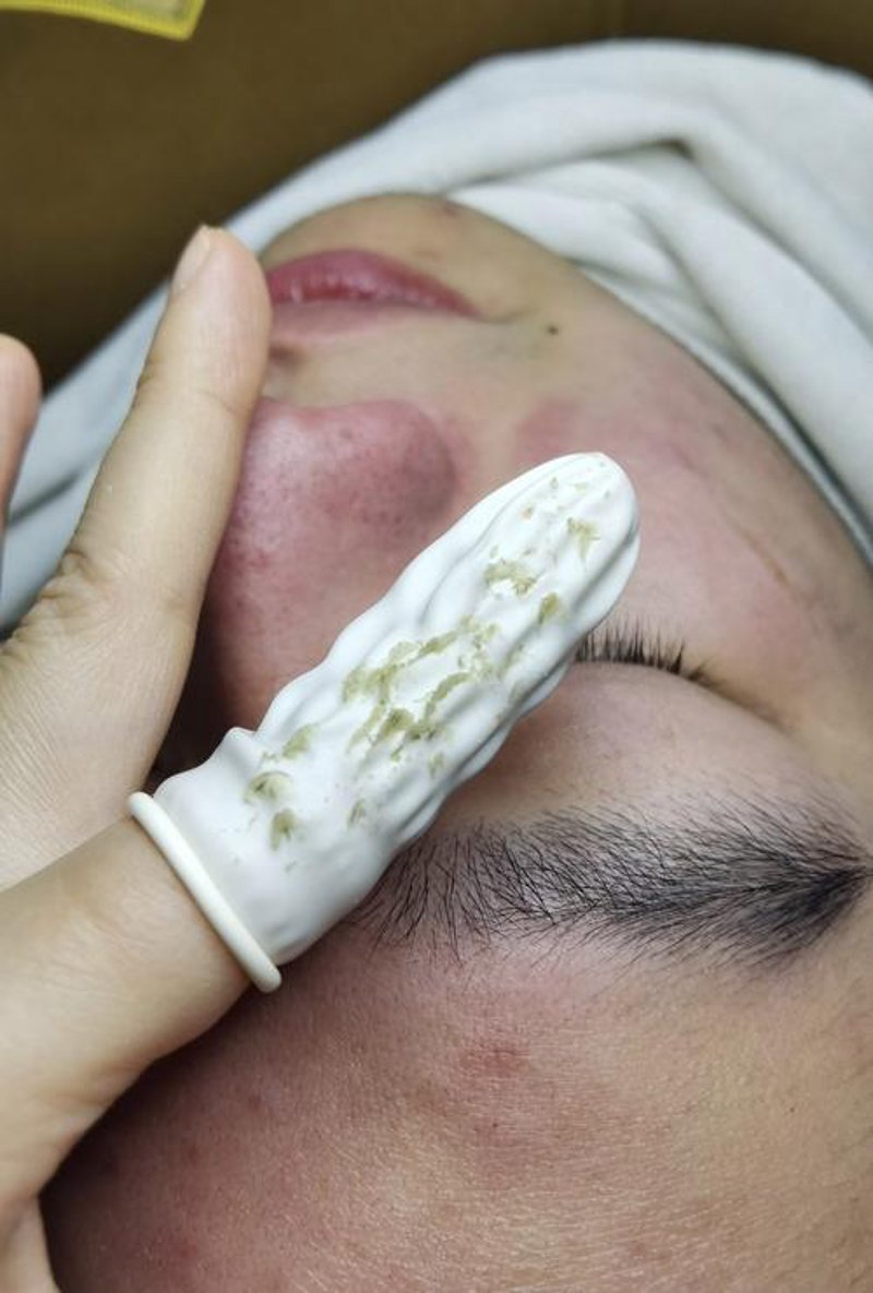 潍坊特色：如何在护肤圣地找到最适合的祛斑祛痘方法
